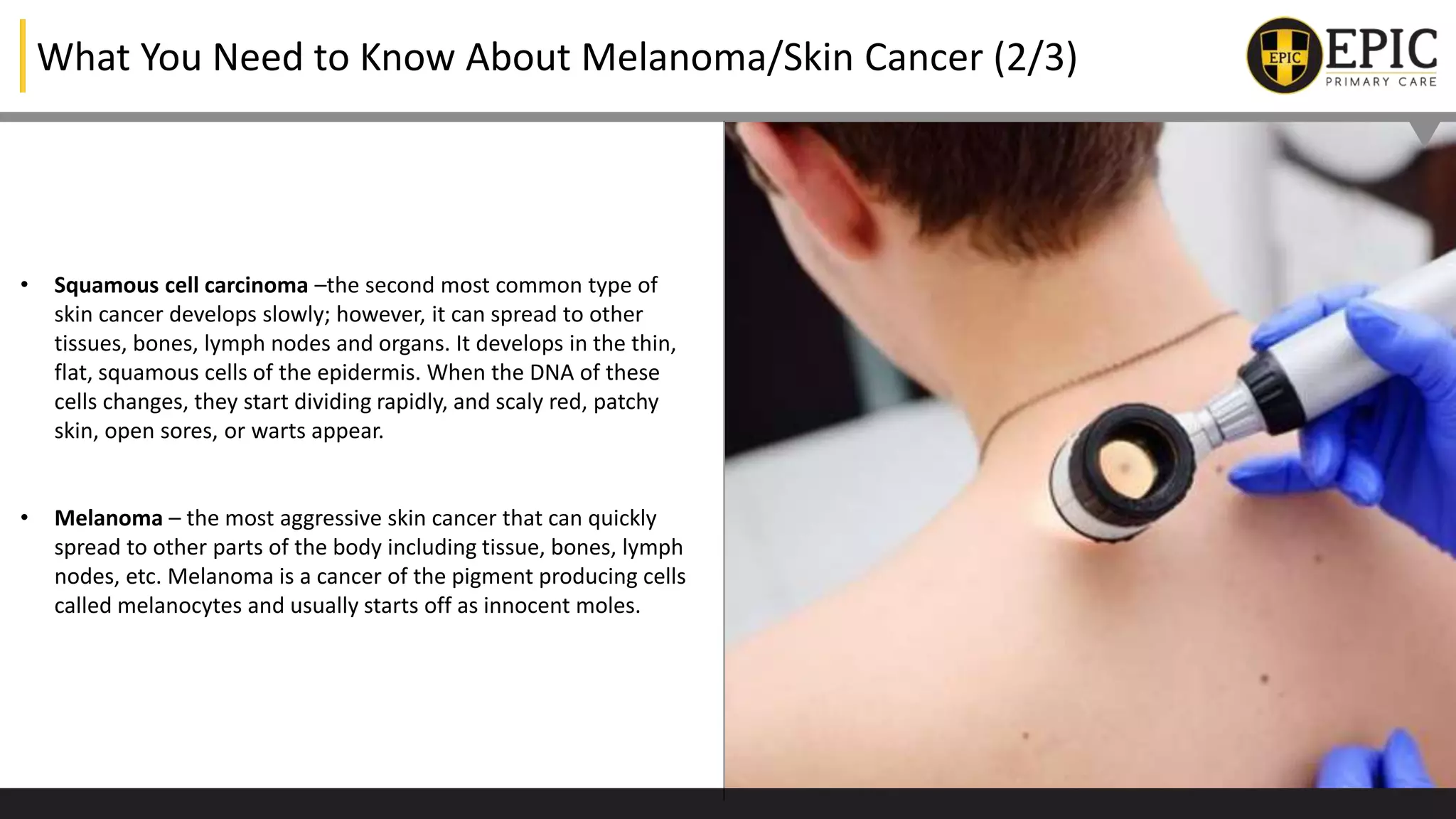 All You Need to Know About Melanoma/Skin Cancer | PPTX
