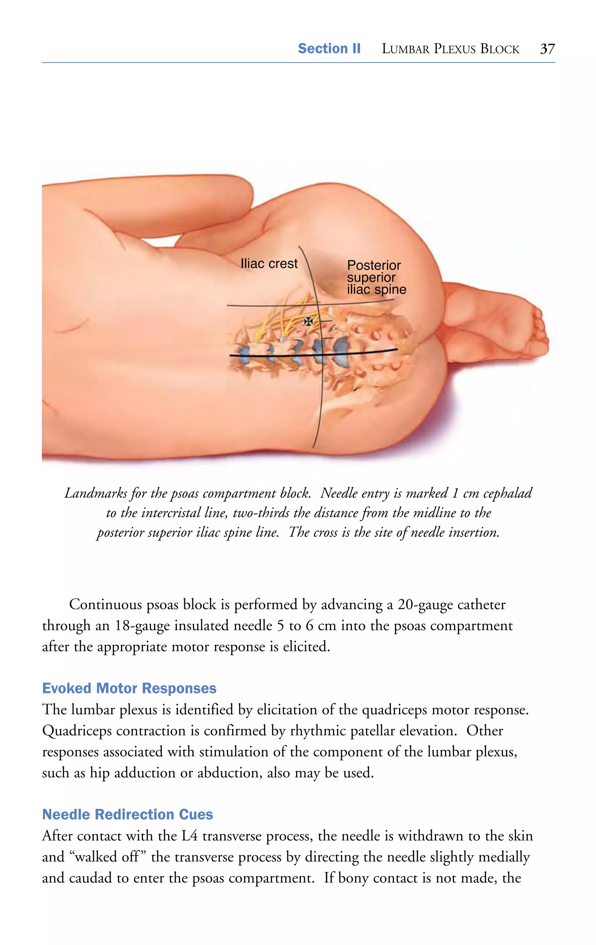 Section II

Iliac crest

LUMBAR PLEXUS BLOCK

Posterior
superior
iliac spine

Landmarks for the psoas compartment block. Needle entry is marked 1 cm cephalad
to the intercristal line, two-thirds the distance from the midline to the
posterior superior iliac spine line. The cross is the site of needle insertion.

Continuous psoas block is performed by advancing a 20-gauge catheter
through an 18-gauge insulated needle 5 to 6 cm into the psoas compartment
after the appropriate motor response is elicited.
Evoked Motor Responses
The lumbar plexus is identified by elicitation of the quadriceps motor response.
Quadriceps contraction is confirmed by rhythmic patellar elevation. Other
responses associated with stimulation of the component of the lumbar plexus,
such as hip adduction or abduction, also may be used.
Needle Redirection Cues
After contact with the L4 transverse process, the needle is withdrawn to the skin
and “walked off ” the transverse process by directing the needle slightly medially
and caudad to enter the psoas compartment. If bony contact is not made, the

37

 