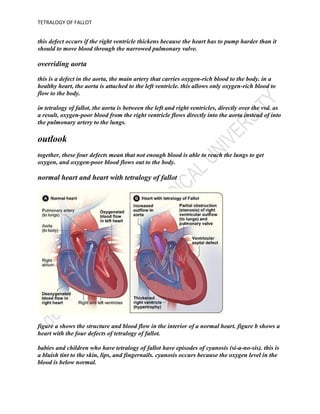 what can be done about tetralogy of fallot?