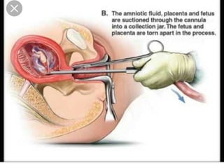 SUCTION EVACUATION
2323
 