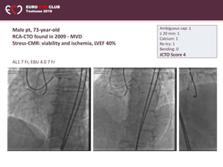 EURO CTO CLUB
Toulouse 2018
AL1 7 Fr, EBU 4.0 7 Fr
Ambiguous cap: 1
≥ 20 mm: 1
Calcium: 1
Re-try: 1
Bending: 0
JCTO Score 4
Male pt, 73-year-old
RCA-CTO found in 2009 - MVD
Stress-CMR: viability and ischemia, LVEF 40%
 