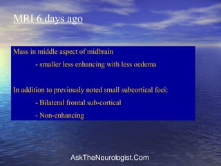 MRI 6 days ago Mass in middle aspect of midbrain - smaller less enhancing with less oedema In addition to previously noted small subcortical foci: - Bilateral frontal sub-cortical - Non-enhancing 
