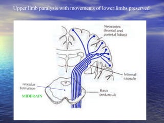 Upper limb paralysis with movements of lower limbs preserved MIDBRAIN 