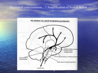 Decreased consciousness…? Amplification of frontal deficit 