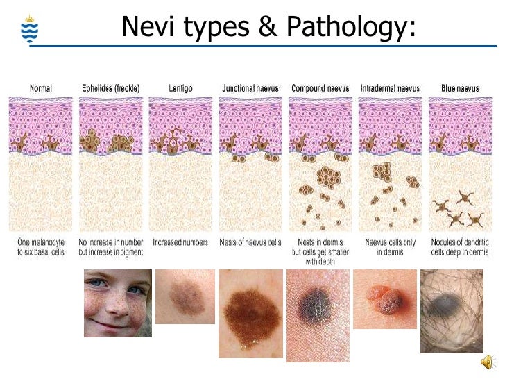 Differentiation of Malignant Melanoma From Benign Nevus ...