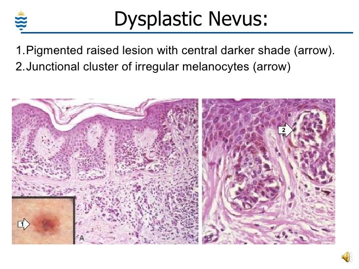 lentiginous junctional nevus #11