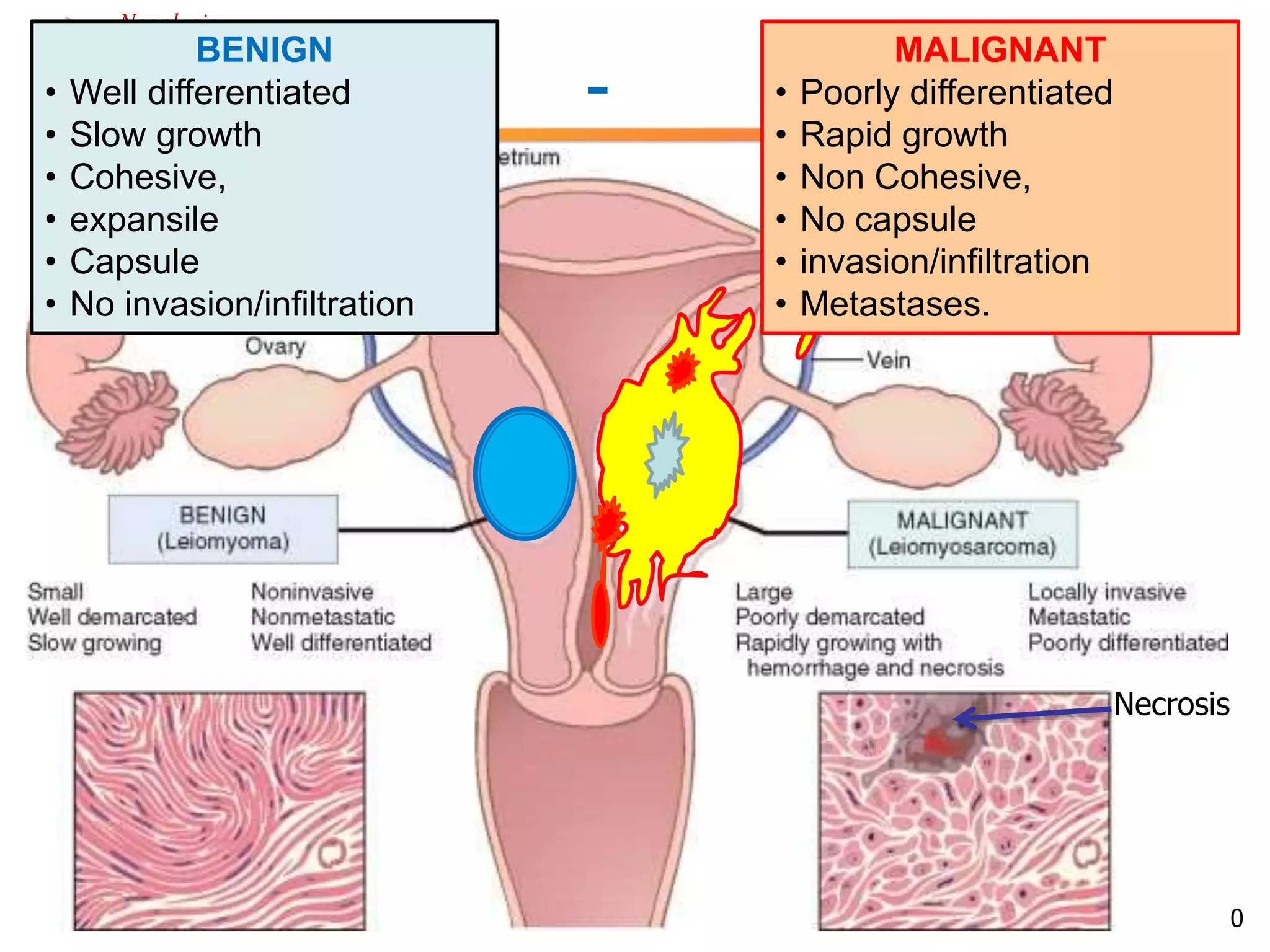 Neoplasia 
Benign - Malignant 
Necrosis 
10 
BENIGN 
• Well differentiated 
• Slow growth 
• Cohesive, 
• expansile 
• Capsule 
• No invasion/infiltration 
MALIGNANT 
• Poorly differentiated 
• Rapid growth 
• Non Cohesive, 
• No capsule 
• invasion/infiltration 
• Metastases. 
 