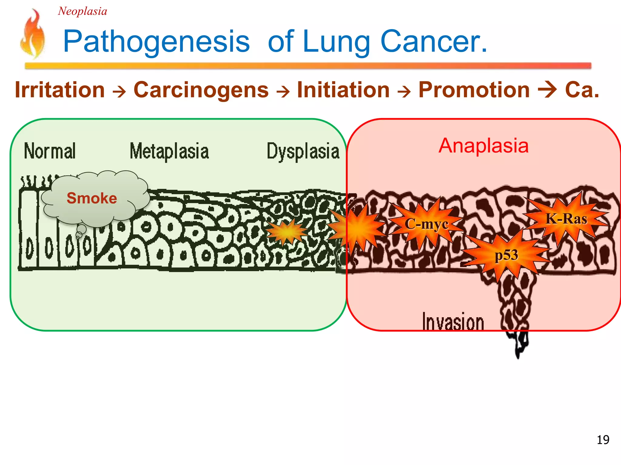Neoplasia 
Irritation  Carcinogens  Initiation  Promotion  Ca. 
19 
Pathogenesis of Lung Cancer. 
C-myc K-Ras 
p53 
Smoke 
Anaplasia 
 
