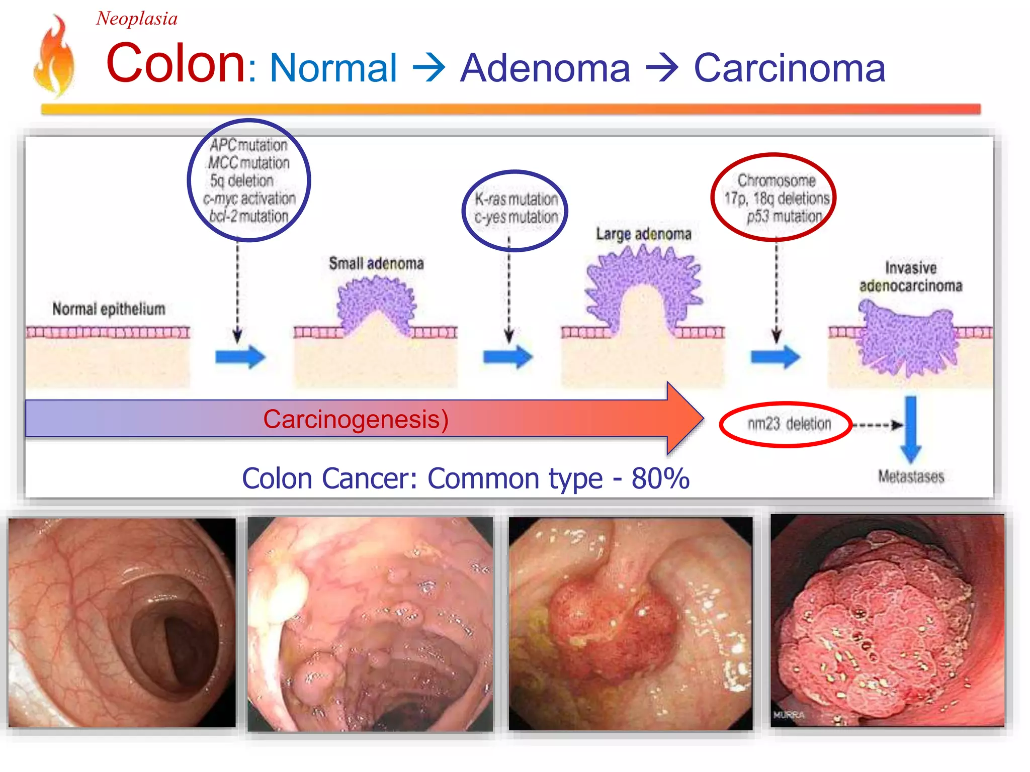 Neoplasia 
Colon: Normal  Adenoma  Carcinoma 
Carcinogenesis) 
Colon Cancer: Common type - 80% 
 