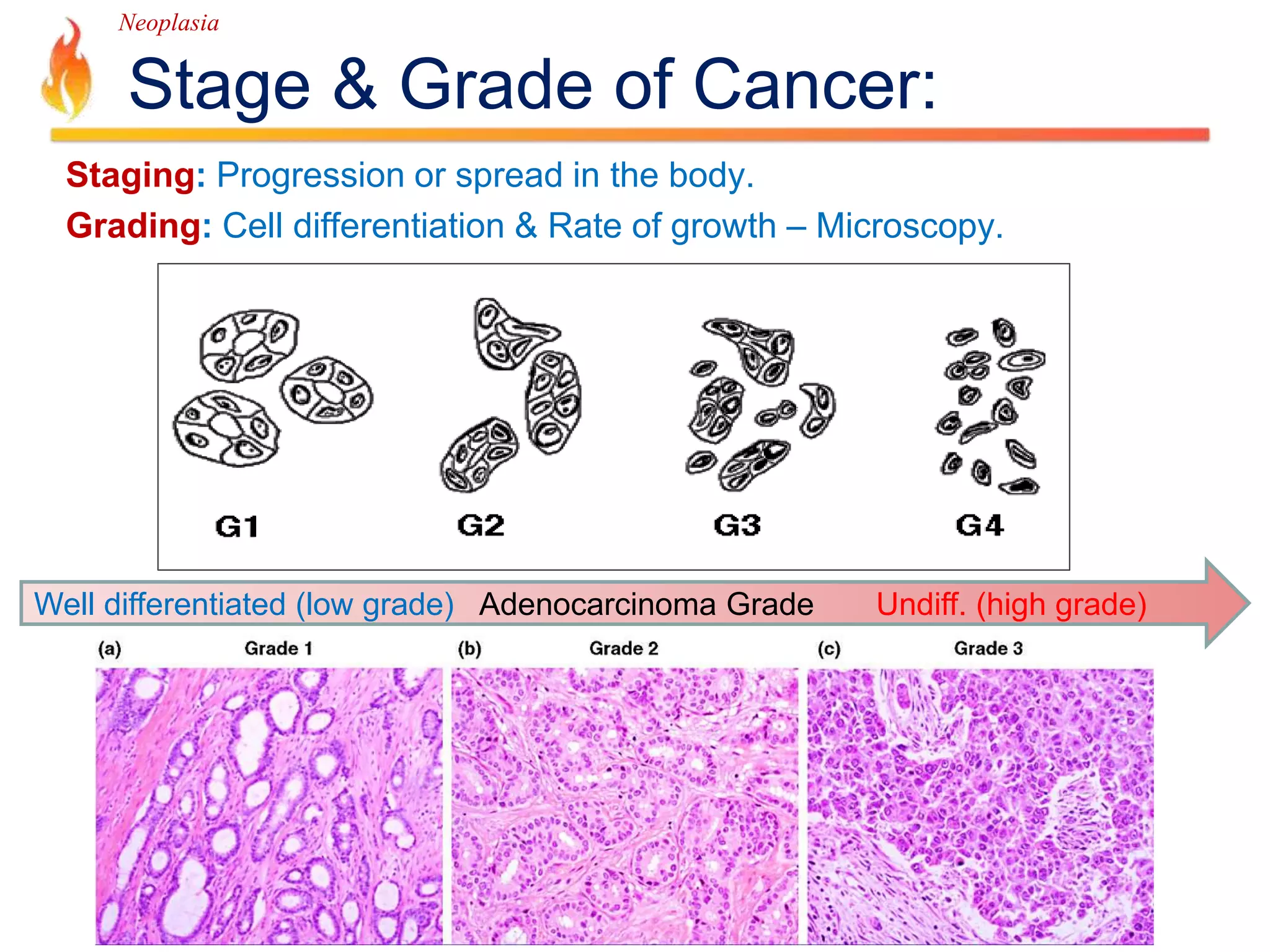 Neoplasia 
Stage & Grade of Cancer: 
Staging: Progression or spread in the body. 
Grading: Cell differentiation & Rate of growth – Microscopy. 
Well differentiated (low grade) Adenocarcinoma Grade Undiff. (high grade) 
 