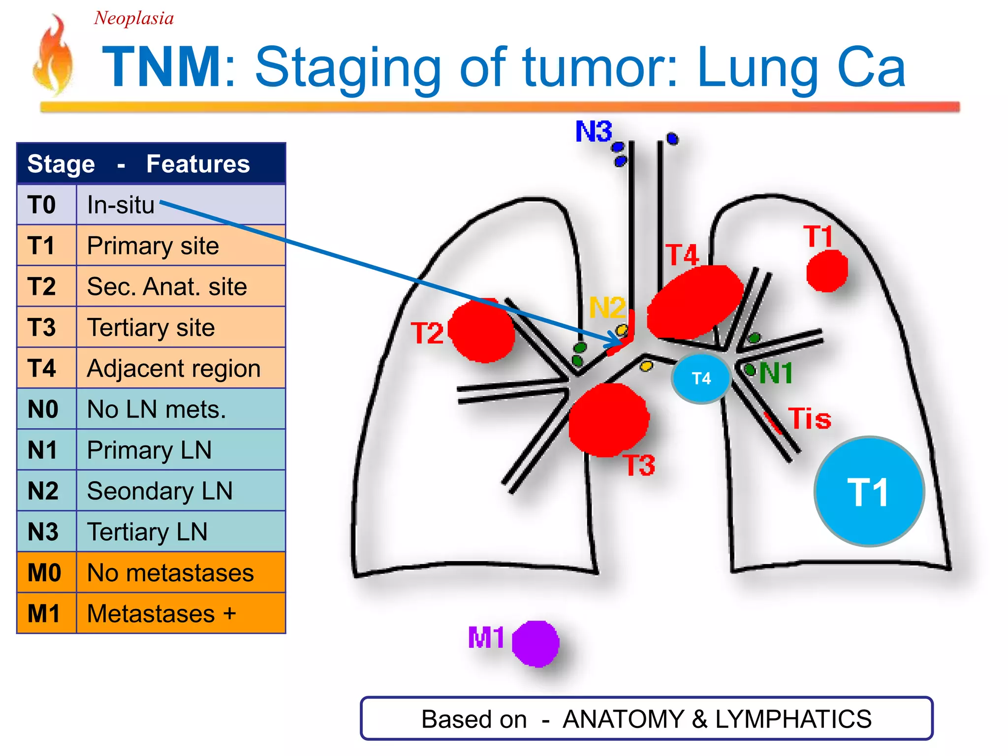 Neoplasia 
TNM: Staging of tumor: Lung Ca 
Stage - Features 
T0 In-situ 
T1 Primary site 
T2 Sec. Anat. site 
T3 Tertiary site 
T4 Adjacent region 
N0 No LN mets. 
N1 Primary LN 
N2 Seondary LN 
N3 Tertiary LN 
M0 No metastases 
M1 Metastases + 
T1 
T4 
Based on - ANATOMY & LYMPHATICS 
 