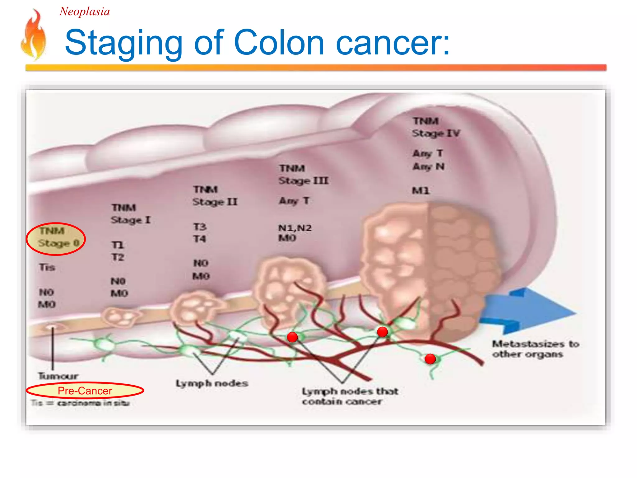 Neoplasia 
Staging of Colon cancer: 
Pre-Cancer 
 