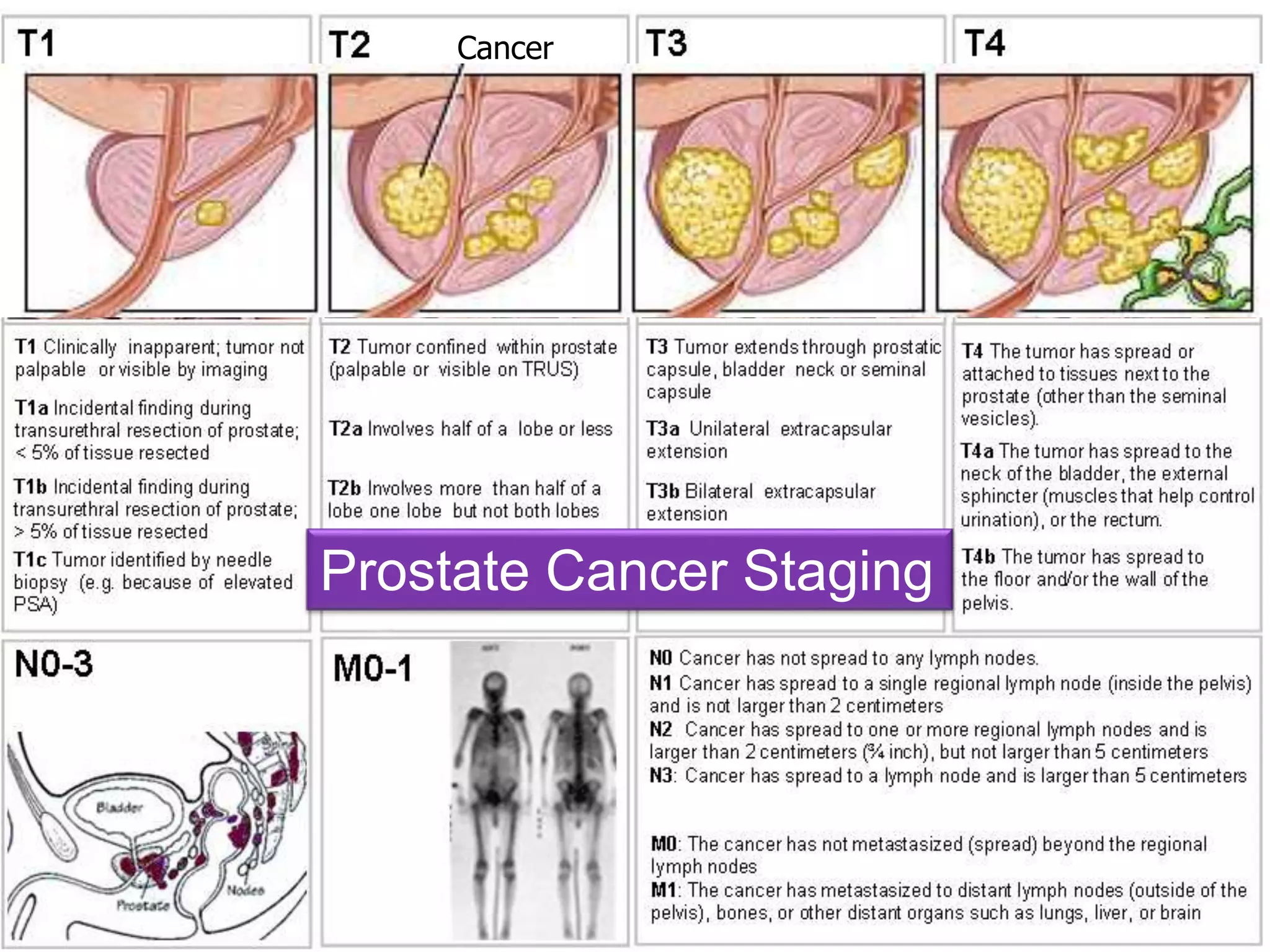 Neoplasia 
26 
Cancer 
Prostate Cancer Staging 
 