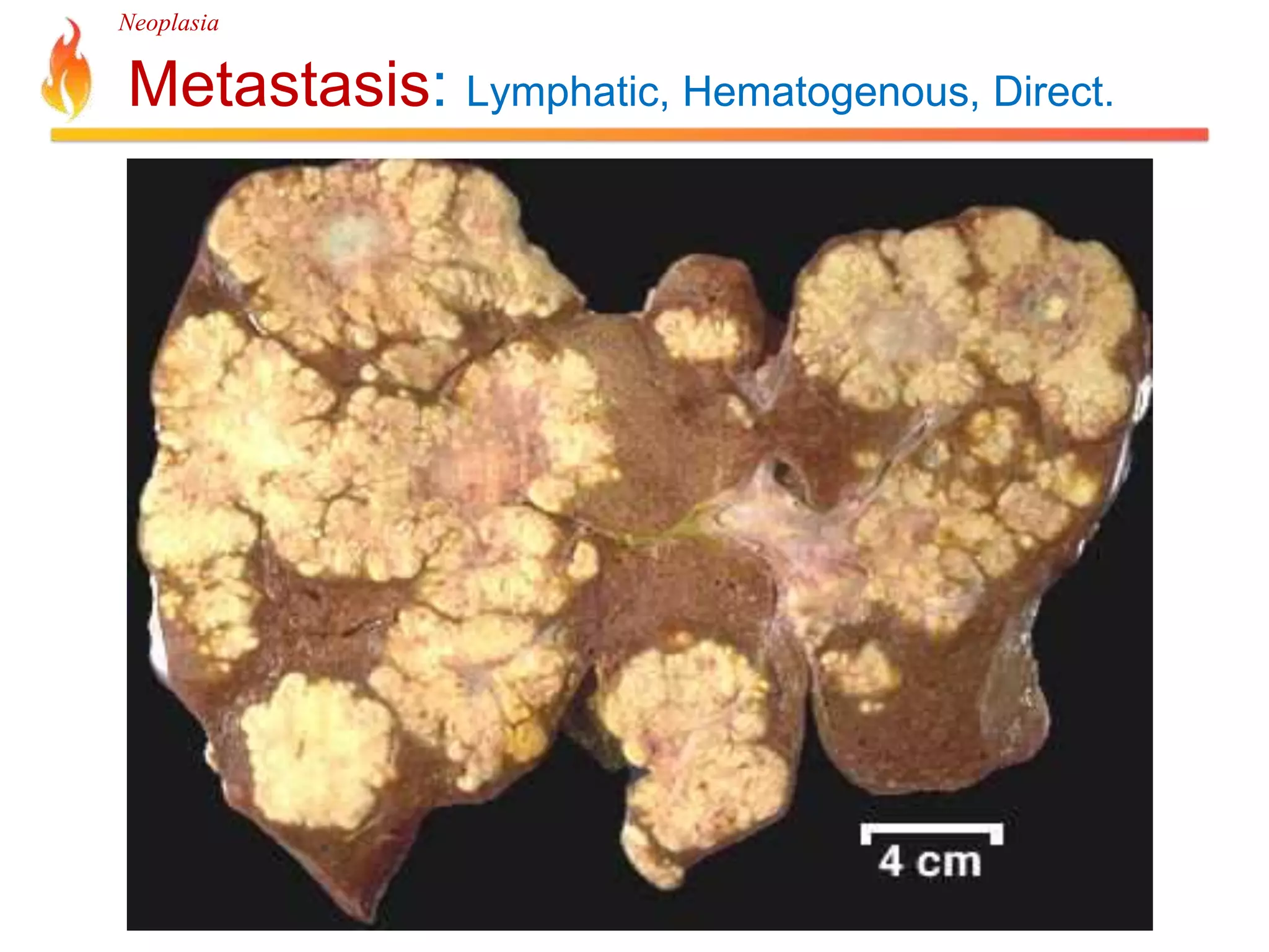 Neoplasia 
Metastasis: Lymphatic, Hematogenous, Direct. 
 