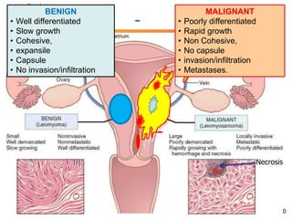 Neoplasia 
Benign - Malignant 
Necrosis 
10 
BENIGN 
• Well differentiated 
• Slow growth 
• Cohesive, 
• expansile 
• Capsule 
• No invasion/infiltration 
MALIGNANT 
• Poorly differentiated 
• Rapid growth 
• Non Cohesive, 
• No capsule 
• invasion/infiltration 
• Metastases. 
 