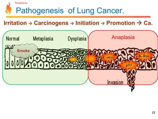 Neoplasia 
Irritation  Carcinogens  Initiation  Promotion  Ca. 
19 
Pathogenesis of Lung Cancer. 
C-myc K-Ras 
p53 
Smoke 
Anaplasia 
 