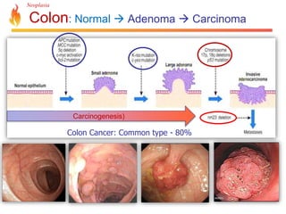 Neoplasia 
Colon: Normal  Adenoma  Carcinoma 
Carcinogenesis) 
Colon Cancer: Common type - 80% 
 