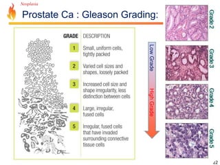 Neoplasia 
Prostate Ca : Gleason Grading: 
22 
Low Grade High Grade 
 