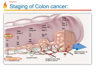 Neoplasia 
Staging of Colon cancer: 
Pre-Cancer 
 