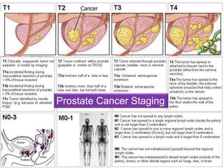 Neoplasia 
26 
Cancer 
Prostate Cancer Staging 
 