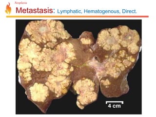 Neoplasia 
Metastasis: Lymphatic, Hematogenous, Direct. 
 