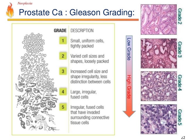 Pathology Lecture - Neoplasia