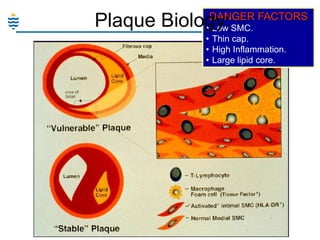 DANGER FACTORS

Plaque Biology:SMC.
• Low

• Thin cap.
• High Inflammation.
• Large lipid core.

 