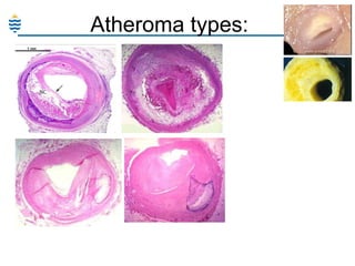 Atheroma types:

 