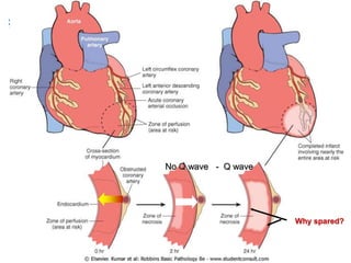No Q wave - Q wave

Why spared?

 
