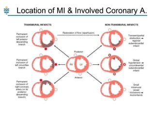 Location of MI & Involved Coronary A.

 