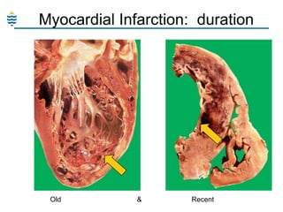 Myocardial Infarction: duration

Old

&

Recent

 