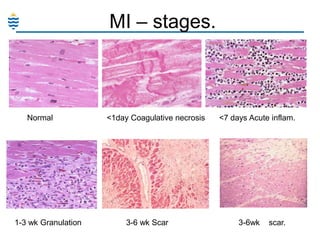 MI – stages.

Normal

1-3 wk Granulation

<1day Coagulative necrosis

3-6 wk Scar

<7 days Acute inflam.

3-6wk

scar.

 