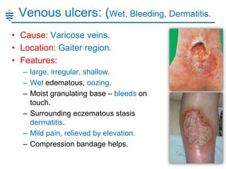 Venous ulcers: (Wet, Bleeding, Dermatitis.
• Cause: Varicose veins.
• Location: Gaiter region.
• Features:
– large, irregular, shallow.
– Wet edematous, oozing.
– Moist granulating base – bleeds on
touch.
– Surrounding eczematous stasis
dermatitis.
– Mild pain, relieved by elevation.
– Compression bandage helps.

 