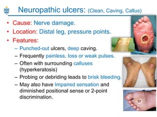 Neuropathic ulcers: (Clean, Caving, Callus)
• Cause: Nerve damage.
• Location: Distal leg, pressure points.
• Features:
– Punched-out ulcers, deep caving.
– Frequently painless, loss or weak pulses.
– Often with surrounding calluses
(hyperkeratosis)
– Probing or debriding leads to brisk bleeding.
– May also have Impaired sensation and
diminished positional sense or 2-point
discrimination.

 