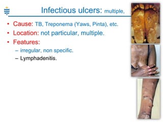 Infectious ulcers: multiple,
• Cause: TB, Treponema (Yaws, Pinta), etc.
• Location: not particular, multiple.
• Features:
– irregular, non specific.
– Lymphadenitis.

 
