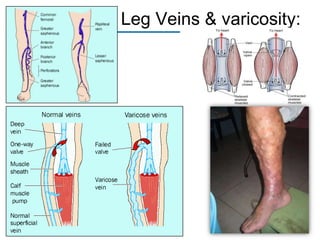 Leg Veins & varicosity:

 