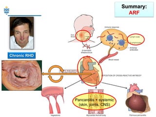 Summary:
ARF

Chronic RHD

Pancarditis + systemic
(skin, joints, CNS)

 