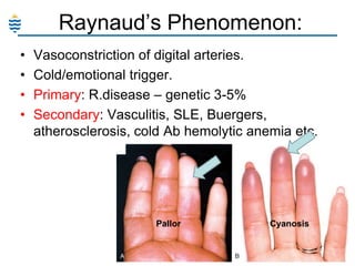 Raynaud‘s Phenomenon:
•
•
•
•

Vasoconstriction of digital arteries.
Cold/emotional trigger.
Primary: R.disease – genetic 3-5%
Secondary: Vasculitis, SLE, Buergers,
atherosclerosis, cold Ab hemolytic anemia etc.

Pallor

Cyanosis

 