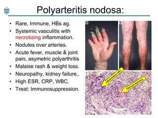 Polyarteritis nodosa:
• Rare, Immune, HBs ag.
• Systemic vasculitis with
necrotizing inflammation.
• Nodules over arteries.
• Acute fever, muscle & joint
pain, asymetric polyarthritis
• Malaise rash & weight loss.
• Neuropathy, kidney failure,.
• High ESR, CRP, WBC.
• Treat: Immunosuppression.

 