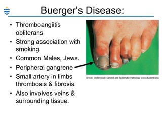 Buerger‘s Disease:
• Thromboangiitis
obliterans
• Strong association with
smoking.
• Common Males, Jews.
• Peripheral gangrene
• Small artery in limbs
thrombosis & fibrosis.
• Also involves veins &
surrounding tissue.

 