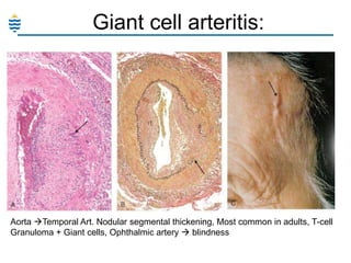 Giant cell arteritis:

Aorta Temporal Art. Nodular segmental thickening, Most common in adults, T-cell
Granuloma + Giant cells, Ophthalmic artery  blindness

 