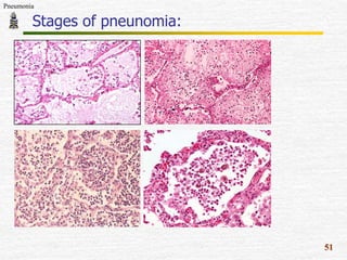 Pneumonia

Stages of pneunomia:

51

 