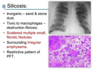 Silicosis:
• Inorganic – sand & stone
dust.
• Toxic to macrophages –
destruction fibrosis.
• Scattered multiple small,
fibrotic Nodules
• Surrounding Irregular
emphysema.
• Restrictive pattern of
PFT.

 