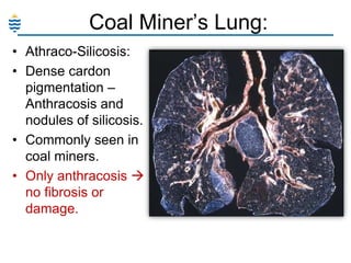 Coal Miner‘s Lung:
• Athraco-Silicosis:
• Dense cardon
pigmentation –
Anthracosis and
nodules of silicosis.
• Commonly seen in
coal miners.
• Only anthracosis 
no fibrosis or
damage.

 