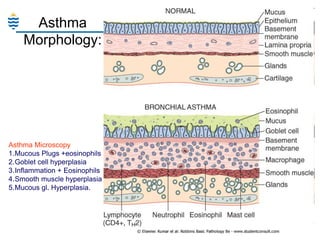Asthma
Morphology:

Asthma Microscopy
1.Mucous Plugs +eosinophils
2.Goblet cell hyperplasia
3.Inflammation + Eosinophils
4.Smooth muscle hyperplasia
5.Mucous gl. Hyperplasia.

 