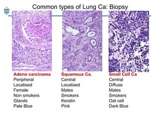Common types of Lung Ca: Biopsy

Adeno carcinoma
Peripheral
Localised
Female
Non smokers
Glands
Pale Blue

Squamous Ca.
Central
Localised
Males
Smokers
Keratin
Pink

Small Cell Ca
Central
Diffuse
Males
Smokers
Oat cell
Dark Blue

 