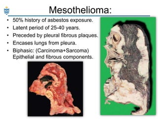 Mesothelioma:
•
•
•
•
•

50% history of asbestos exposure.
Latent period of 25-40 years.
Preceded by pleural fibrous plaques.
Encases lungs from pleura.
Biphasic: (Carcinoma+Sarcoma)
Epithelial and fibrous components.

 