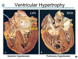 Ventricular Hypertrophy
LVH

RVH

>2 cm

Systemic Hypertension

Pulmonary Hypertension

88

 