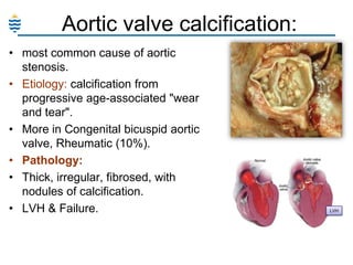 Aortic valve calcification:
• most common cause of aortic
stenosis.
• Etiology: calcification from
progressive age-associated "wear
and tear".
• More in Congenital bicuspid aortic
valve, Rheumatic (10%).
• Pathology:
• Thick, irregular, fibrosed, with
nodules of calcification.
• LVH & Failure.

LVH

 