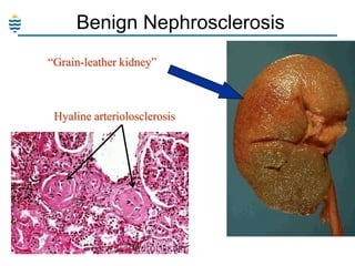 Benign Nephrosclerosis
“Grain-leather kidney”

Hyaline arteriolosclerosis

 